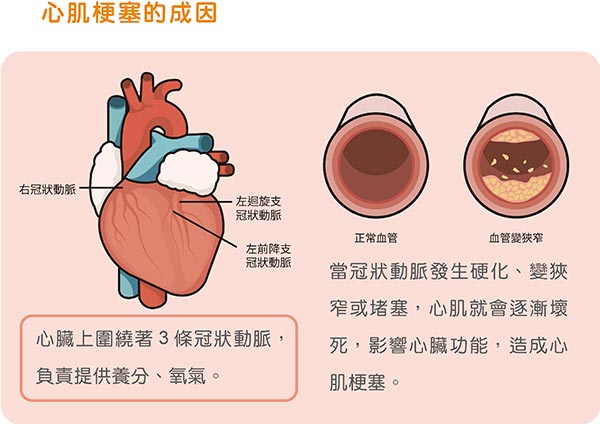 心肌梗塞的成因