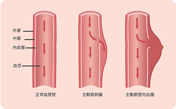 主動脈剝離原因：血液衝破血管內膜，流竄到血管外層與內膜中間。