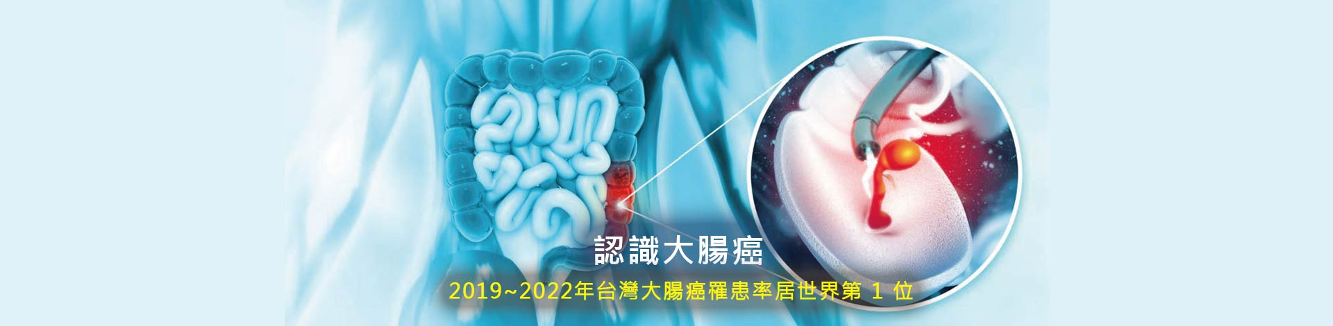 認識大腸癌-2019~2022年台灣大腸癌罹患率居世界第 1 位