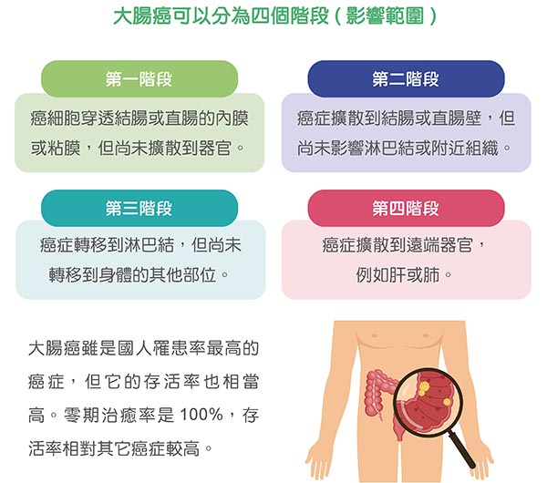 大腸癌分期可以分為四個階段 ( 影響範圍 )
