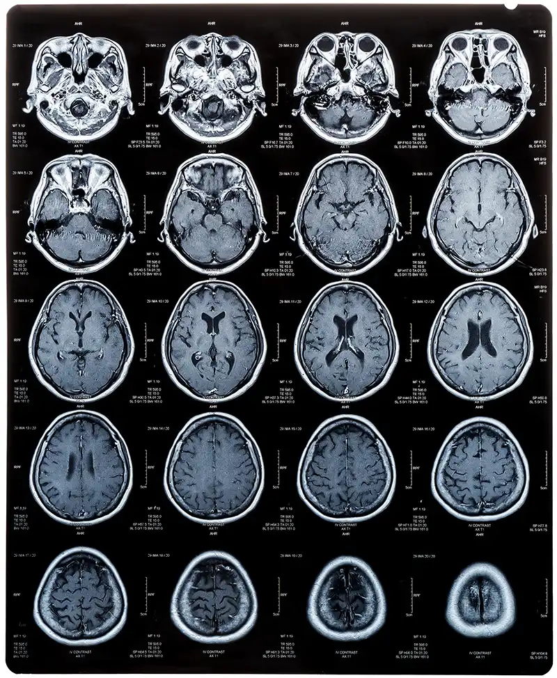 糖尿病與失智症的影響：老年患者磁振造影 (MRI) ，用於腦部疾病的神經醫學診斷。