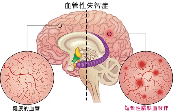 短暫性腦缺血發作是大腦血管性失智症的原因之一。