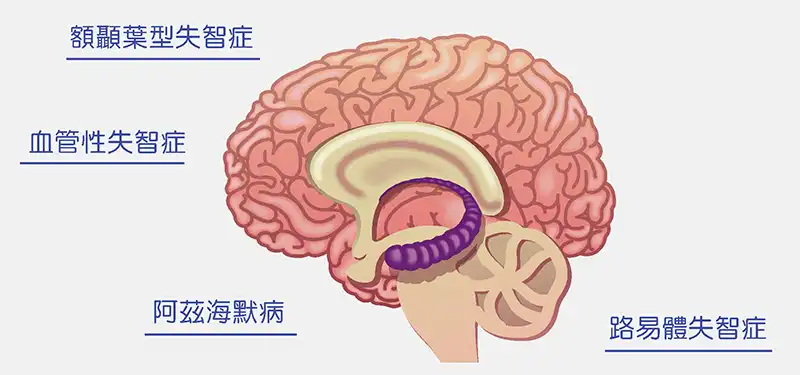 失智症分哪幾種？
